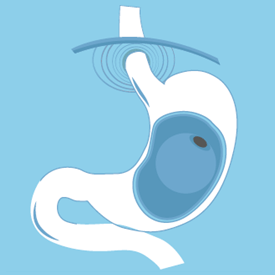 gastric-balloon Gastric balloon diagram