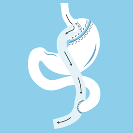 gastric-bypass Gastric bypass diagram